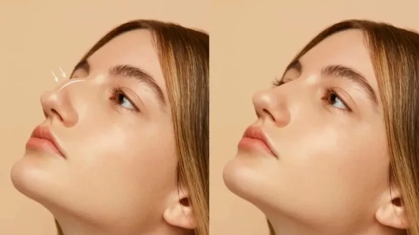 Innovative Non Surgical Rhinoplasty Services in Dubai