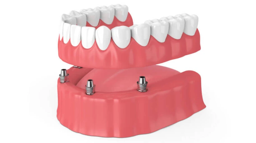 Full Mouth Rehabilitation in Dubai for Complex Dental Needs