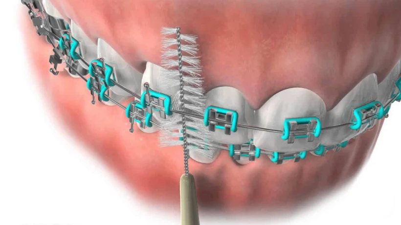 Affordable Clear Braces & Expert Overbite Correction in League City – Smile with Confidence!