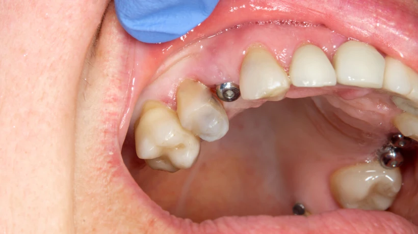 Could Full Mouth Dental Implants Cost Unlock Your Perfect Bite Instantly