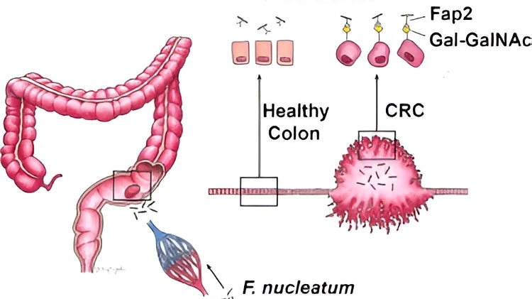Early Detection in Gastro Health: How Imaging Advances are Changing Colon Cancer Screening