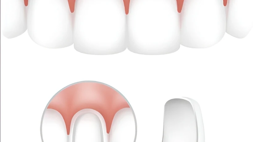 Can You Get Dental Veneers If You Have Periodontal (Gum) Disease?