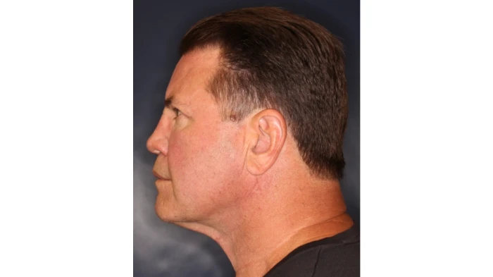 Facelift La Jolla: Complete Guide To Youthful Facial Rejuvenation