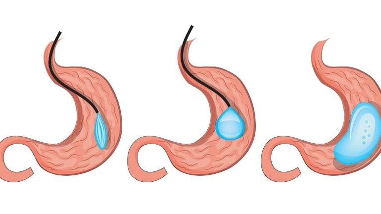 Gastric Balloon Turkey