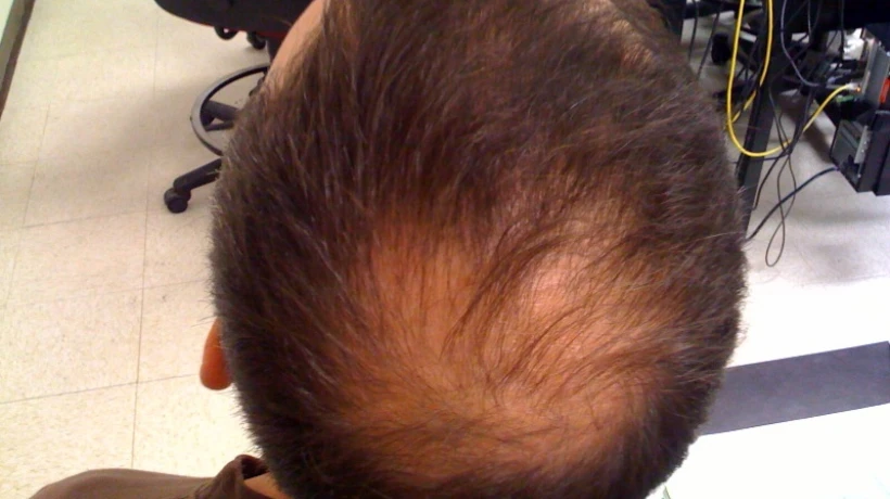 Can crown hair transplant restore thinning crown areas?