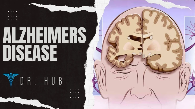 The Role of Neurologists in Alzheimer’s Disease Care in Santa Fe