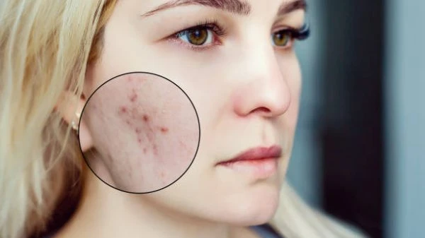 Brad Pitt’s Acne Scar Treatment: Understanding Acne Scars