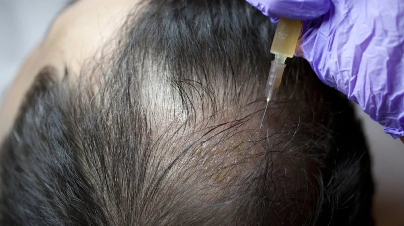 Can G Cell Hair Treatment Prevent Further Hair Loss?