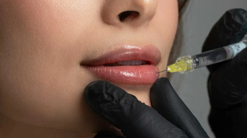 Lip Fillers injection can it elevate lip beauty instantly?