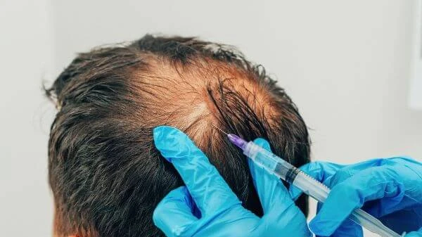 Can GFC Treatment For Hair Control Excessive Hair Shedding?