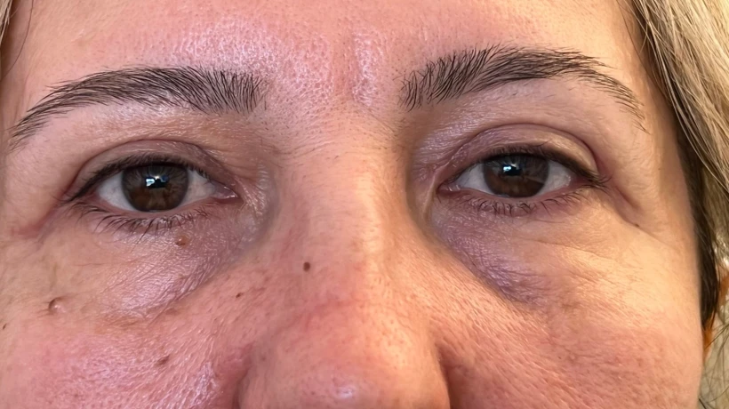How Long Does a Blepharoplasty Procedure Take?