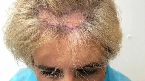 How Does Hair Transplant Redesign Your Front Hairline?