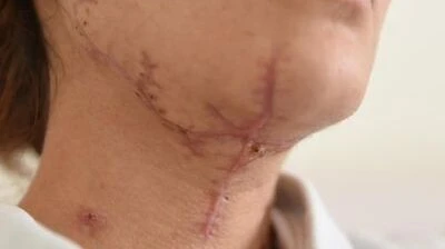 Can Scar Removal Help With Discoloration and Dark Marks?