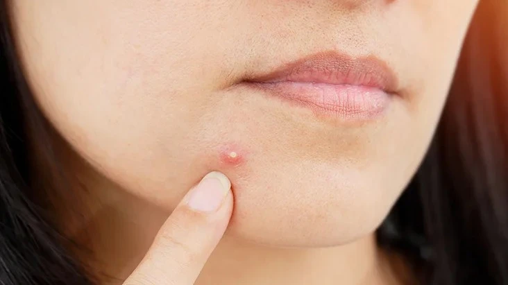 How Fast Does Pimples Treatment Work on Acne Breakouts?