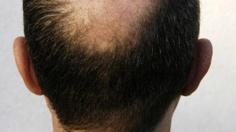How Do Final Results Look After Crown Hair Restoration?