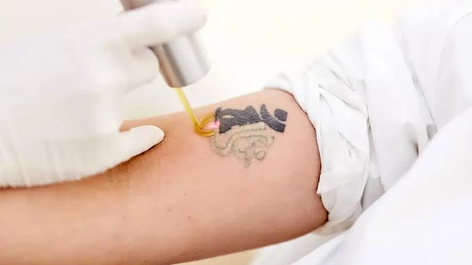 Does Skin Tone Affect Laser Tattoo Removal Effectiveness?