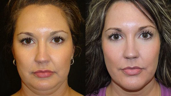 Is Botox Chin Before and After Safe for Every Skin?