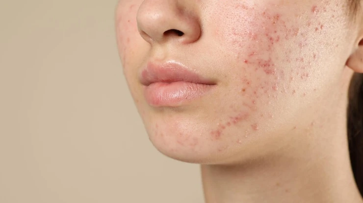 Can the Best Acne Treatment Help with Acne Scars Too?