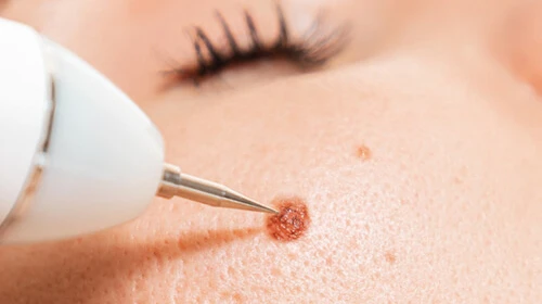 Can Skin Tag Removal Improve Skin Hygiene and Clean Look?