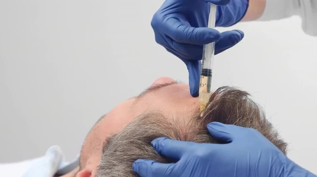 Do PRP Treatments Improve Hair Thickness Naturally?