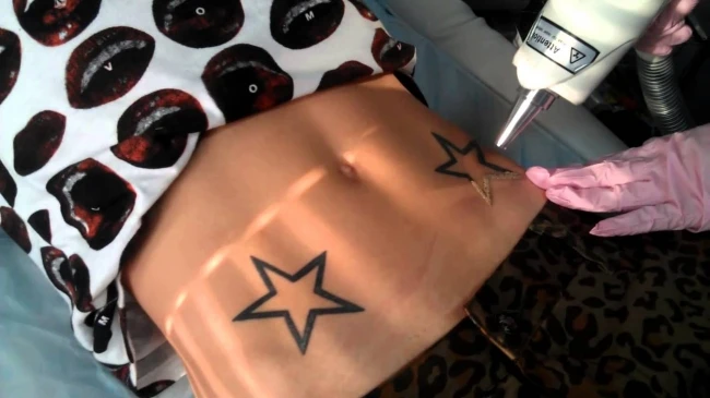 Why Do People Prefer Laser Tattoo Removal Treatments Today?