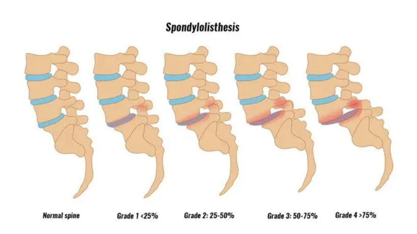 How Minimally Invasive Spine Surgery Helps Treat Spondylolisthesis