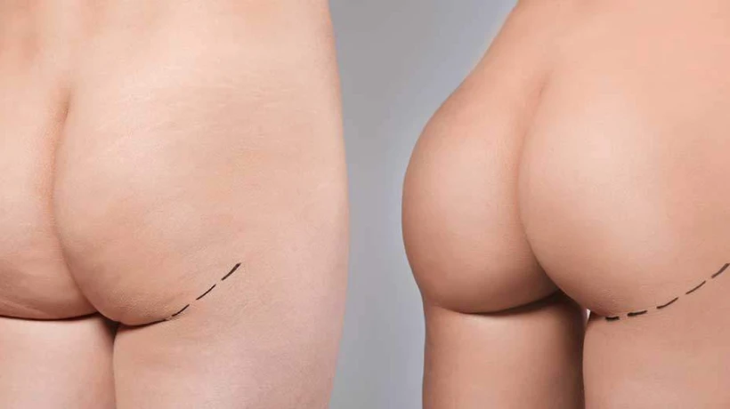 Brazilian Butt Lift for Beginners: Step-by-Step Guide
