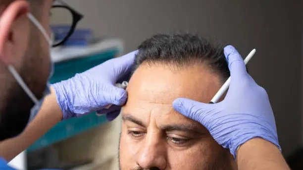 Can Hair Transplant Heal Without Visible Linear Scars?