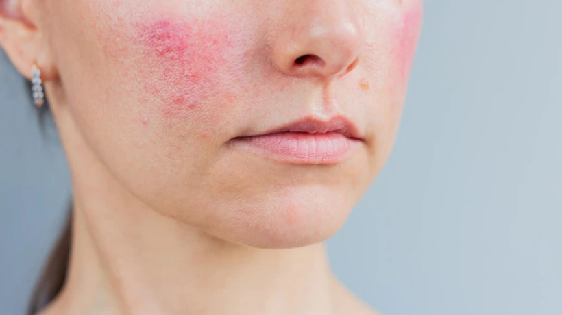 Does Facial Capillary Treatment Work on All Skin Tones?