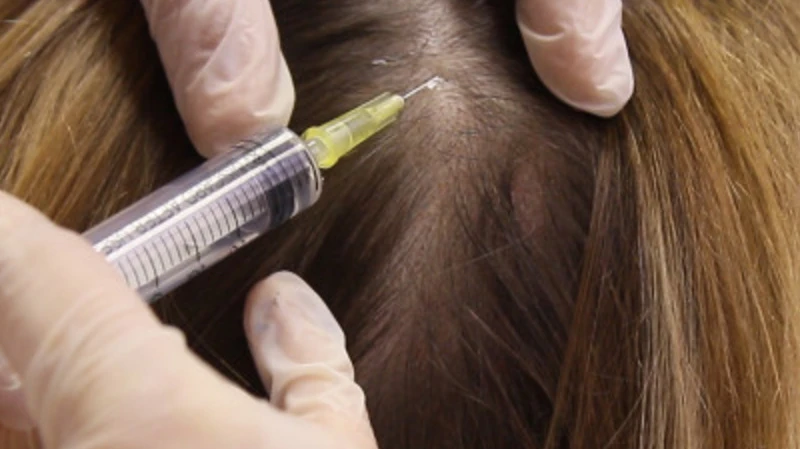 Can GFC Treatment Help Reduce Hair Fall Effectively?