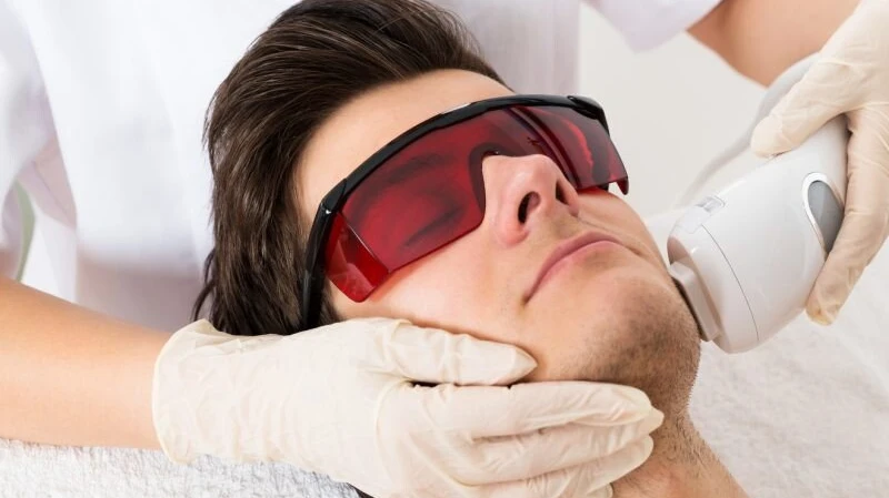 How Many Sessions Do Men Need for Laser Hair Removal?