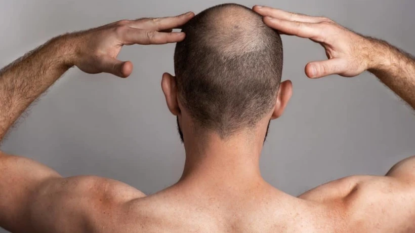 Can crown hair transplant improve overall scalp coverage?