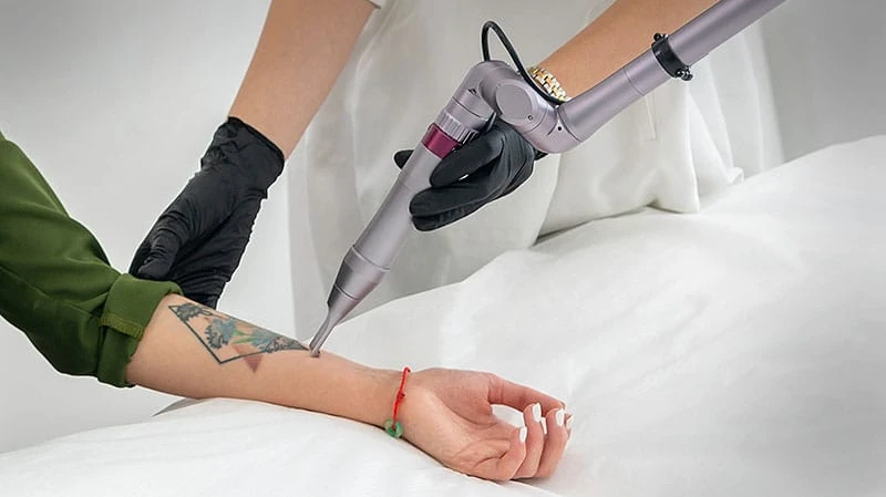 How Many Sessions Are Needed for Laser Tattoo Removal?