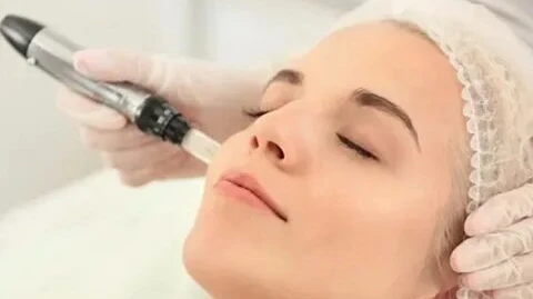 Can Microneedling Reduce Acne Scars Effectively?