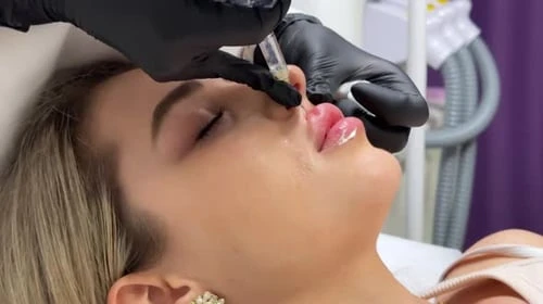 What Should You Know Before Getting a Lip Flip Treatment?