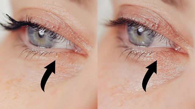 Milia Treatment in Dubai pure radiant finish skin clarity upgrade