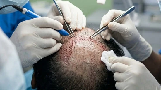 How Painful Is FUSS Hair Transplant Procedure Really?