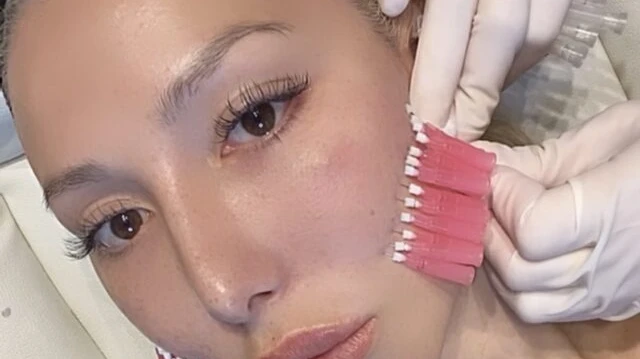 Who Should Consider PDO Mono Threads for Skin Rejuvenation?