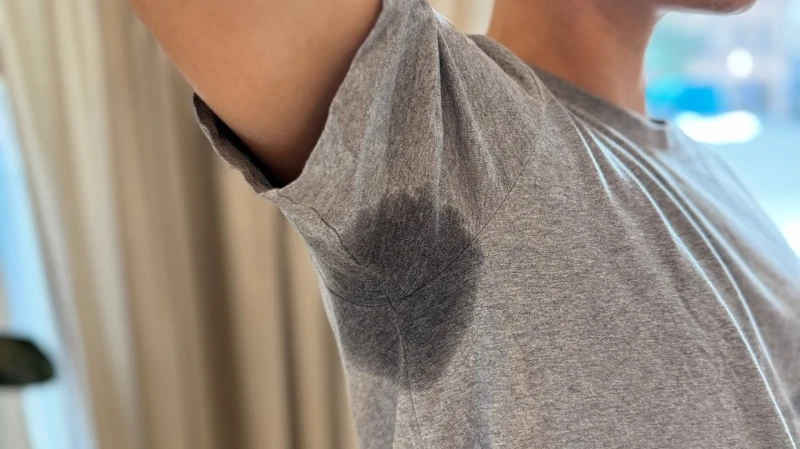 How Does Hyperhidrosis Treatment Work for Underarms?