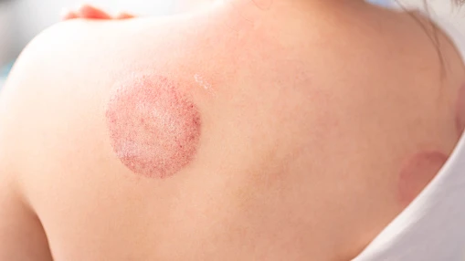 What Happens to Skin After Keloid Treatment?