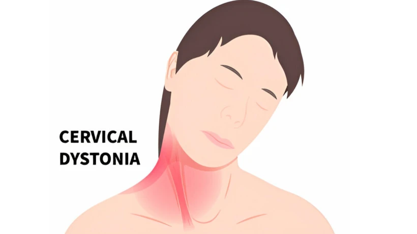 Cervical Dystonia Symptoms Often Mistaken for Other Conditions