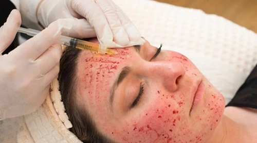 Does a Vampire Facial Tighten Loose Skin Naturally?