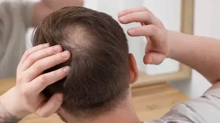 Can Crown Hair Transplant Help with Hair Regrowth Goals?