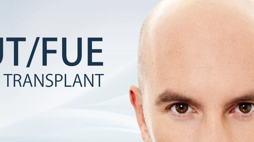 Why are more Indian men and women in their twenties and thirties proactively seeking hair transplants? Read to know the five major 5 reasons behind it.