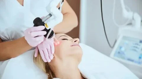 Does Pico Laser Reduce Hyperpigmentation Fast?