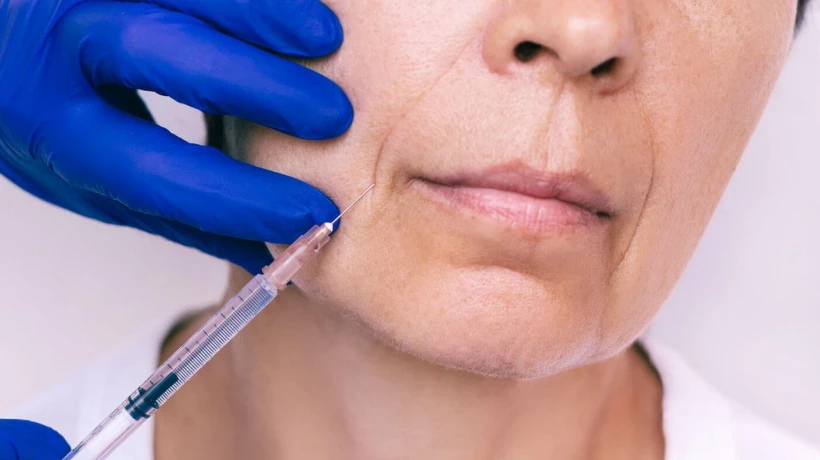 Do Volift Fillers Work Well for Smile Lines?