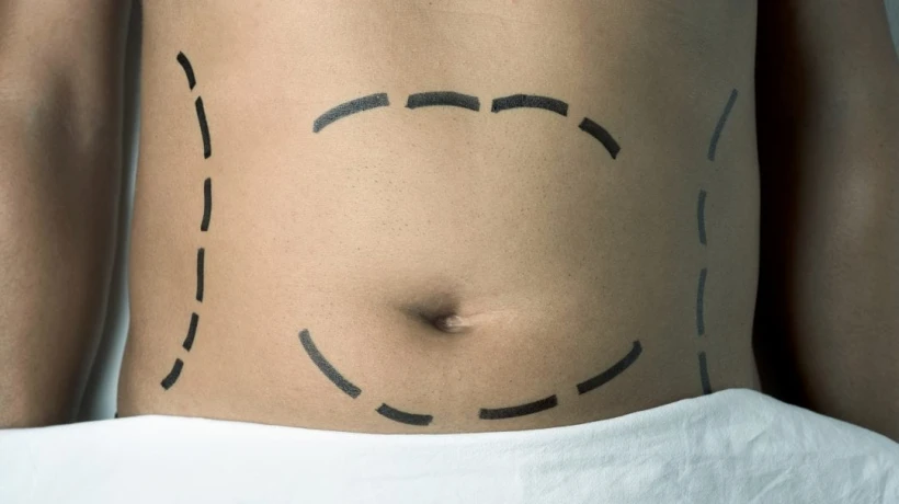 Most Recommended Clinics for Liposuction in Dubai