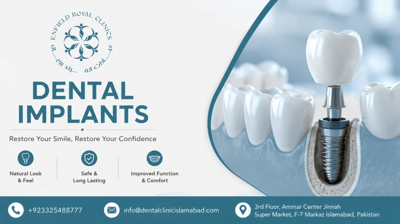 Best Dental Implants in Islamabad for Missing Teeth