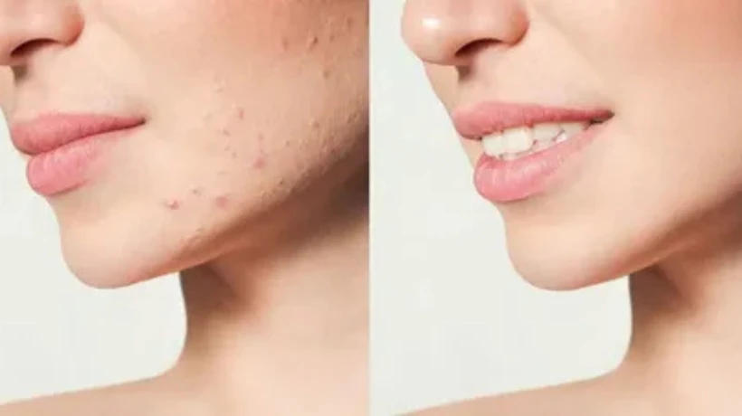 Acne Scars Treatment in Delhi: Effective Solutions for Clearer and Healthier Skin