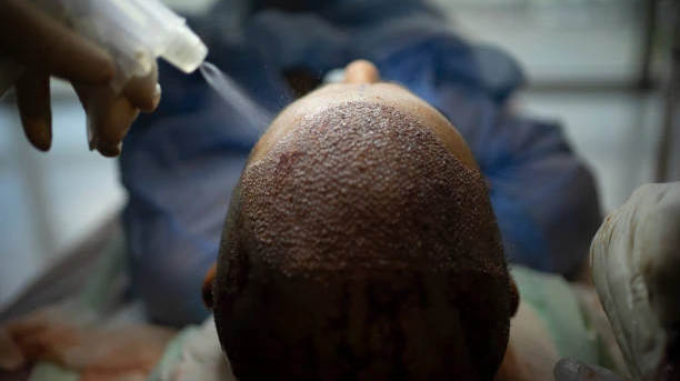 Common Mistakes to Avoid After a Hair Transplant
